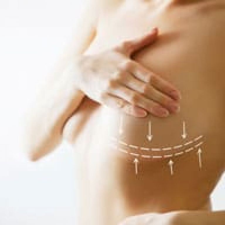 Brustvergrößerung mit Implantaten München