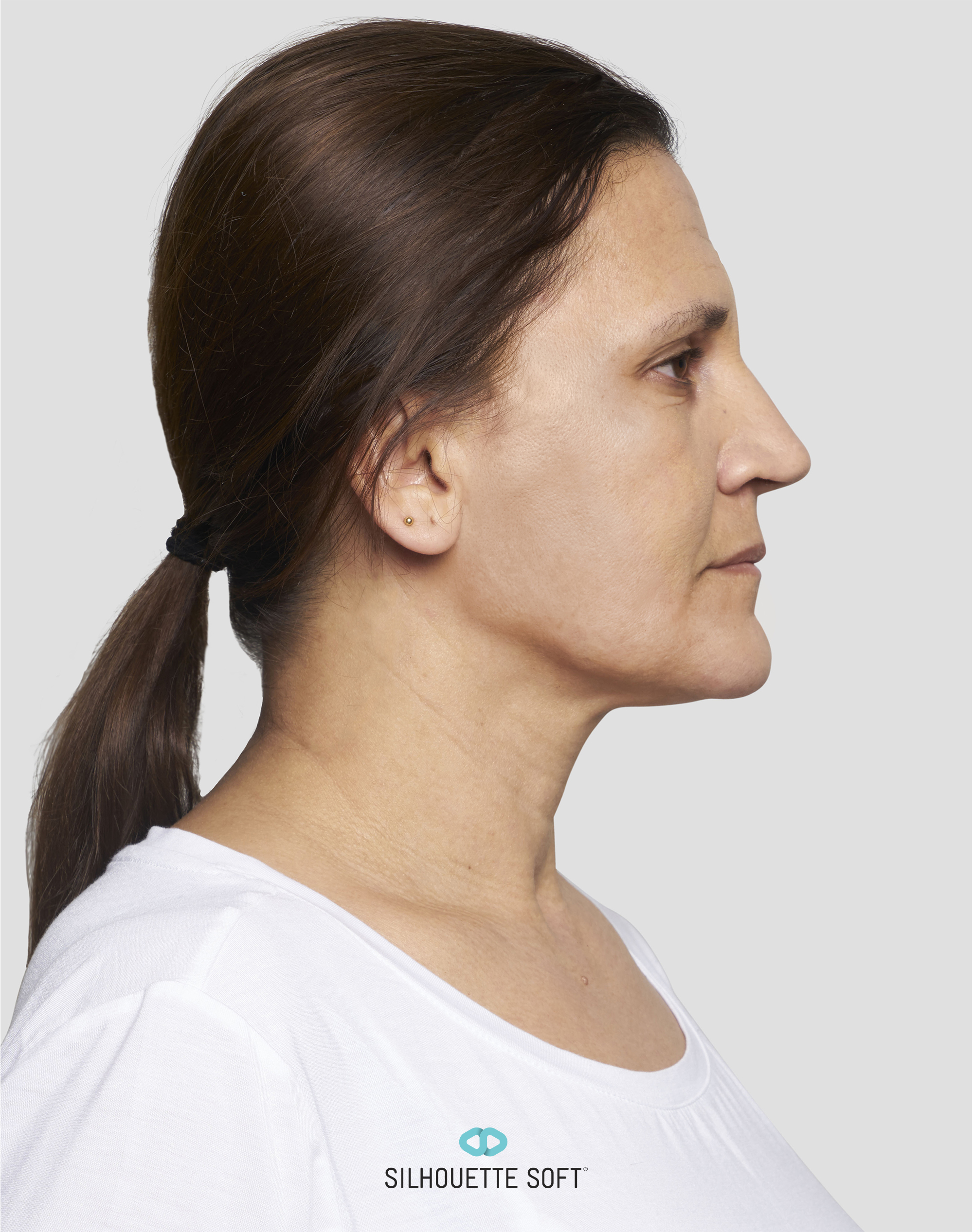 Silhouette Soft® - Bild 04 - Praxis Dr. Raab München