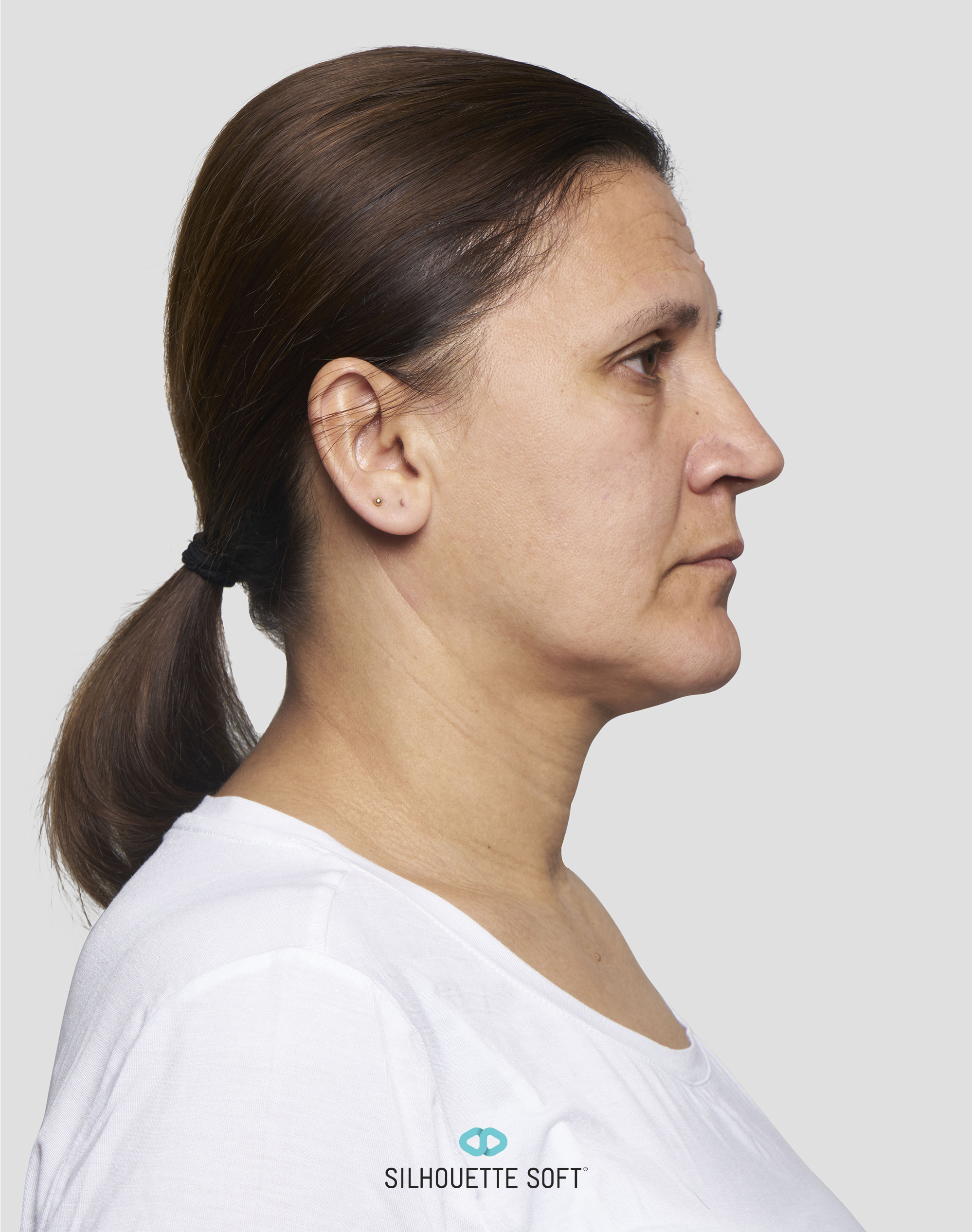 Silhouette Soft® - Bild 03 - Praxis Dr. Raab München