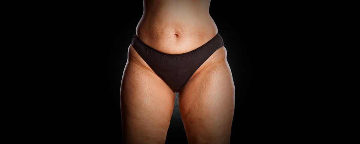 Cellulite Entfernung