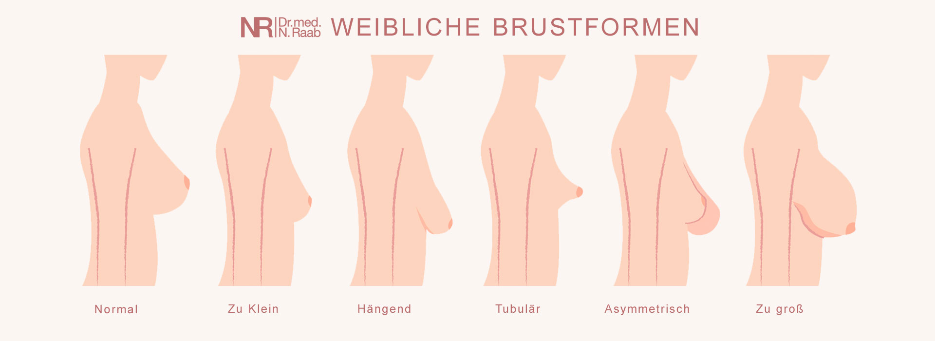 Brustkorrektur München - Weibliche Brustformen und Anomalien
