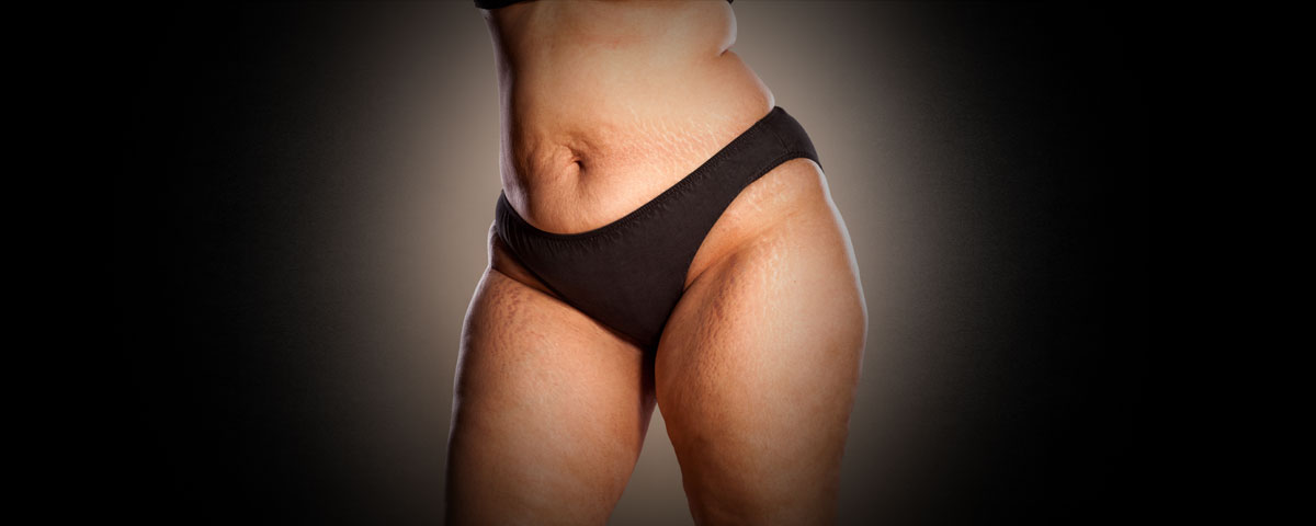 Liposuktion bei Lipödem