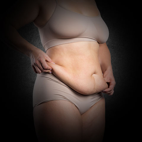 Vaser Lipo Fettschürze entfernen