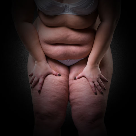 Vaser Liposuction Bauchfett entfernen