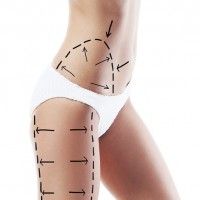 عمليات شفط الدهون