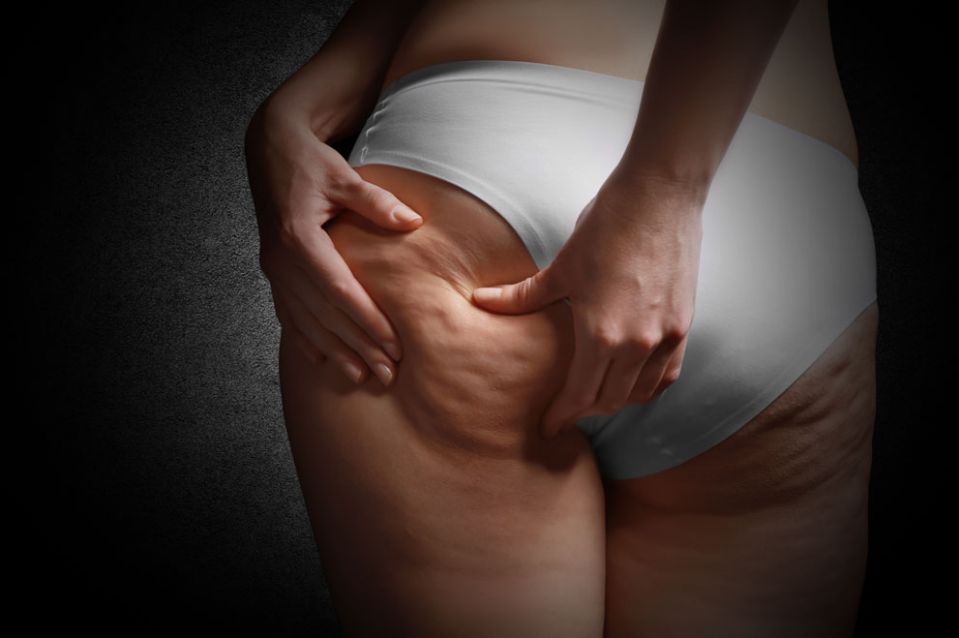 Schwangerschafts-Cellulite