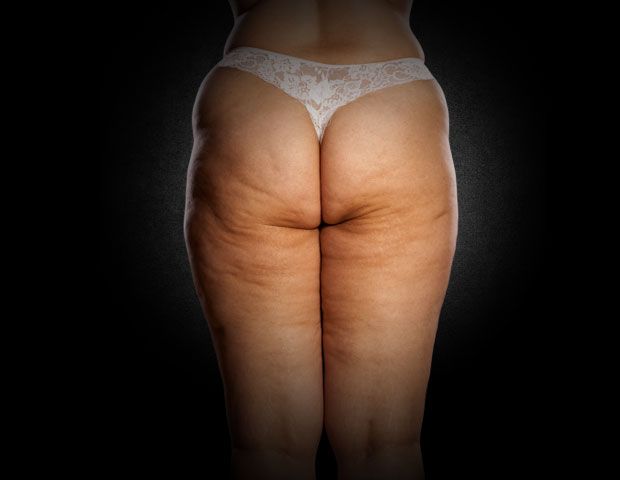 Lipödem Akademie | Lipödem Behandlung Dr. Raab