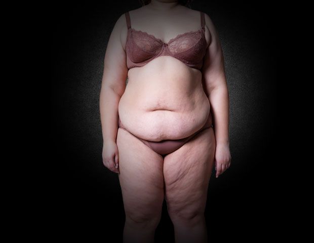 Lipödem Akademie | Lipödem Therapie Dr. Raab