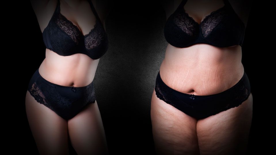 Vaser Ultraschall Fettabsaugung Dr. Raab