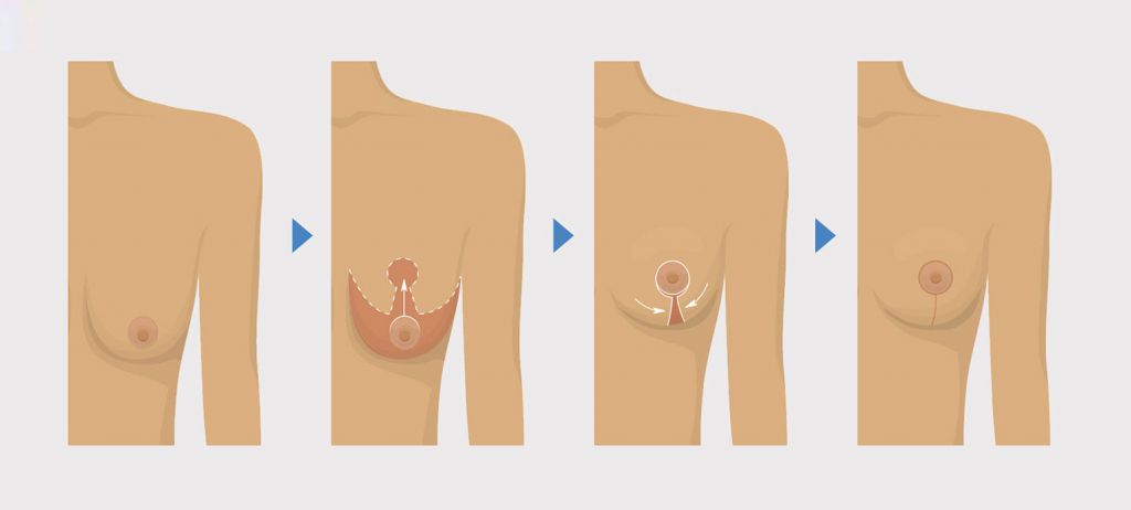 Bruststraffung nach Schwangerschaft