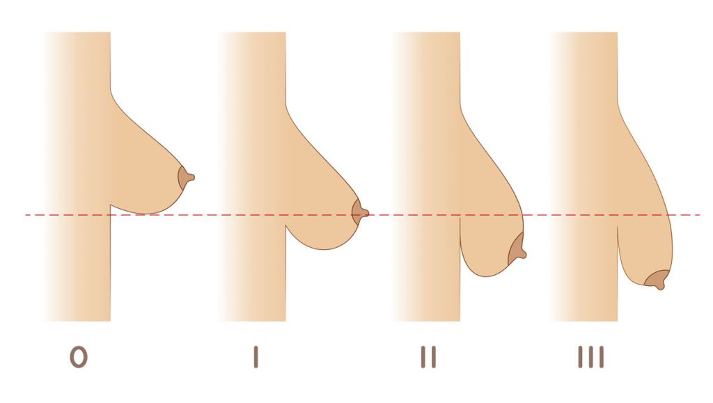 Hängebusen Schweregrade