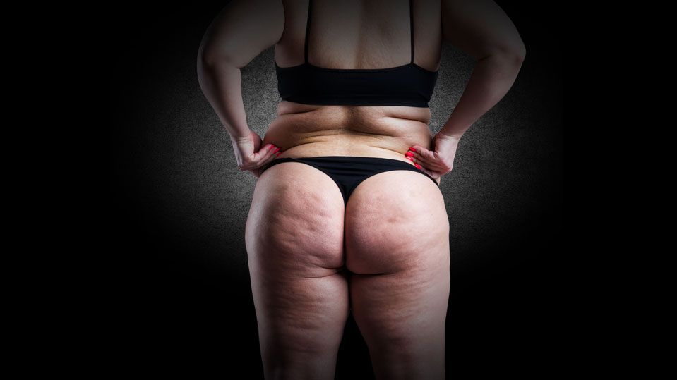 Lipödem Akademie | Vaser-Liposuktion Dr. Raab