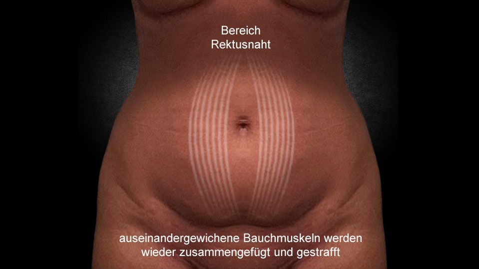 04-bereich-rektusnaht
