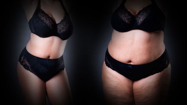 vaser-ultraschall-fettabsaugung